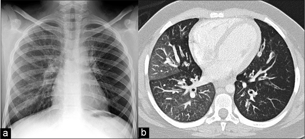 Chest radiograph (a) and axial CT scan images (b) of chronic obstructive airway disease in a 10-year-old girl with Down syndrome: Hyperlucent left lung on chest radiograph indicates hypoperfusion and air trapping of the left lung. Mosaic attenuation pattern of lung fields and thickened, dilated bronchi are typical CT signs of post-infectious bronchiolitis obliterans with bronchiectasis.