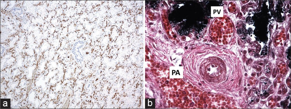 Alveolar capillary dysplasia. (a) CD31 stain showing thickening of the interstitium and very little alignment between the very primitive alveolar spaces and the vasculature, (b) The pulmonary artery and vein is apposed in the bronchovascular bundle “Misaligned pulmonary veins.” Note the severe pulmonary hypertensive changes, with intimal proliferation and greatly increased medial muscle thickness.