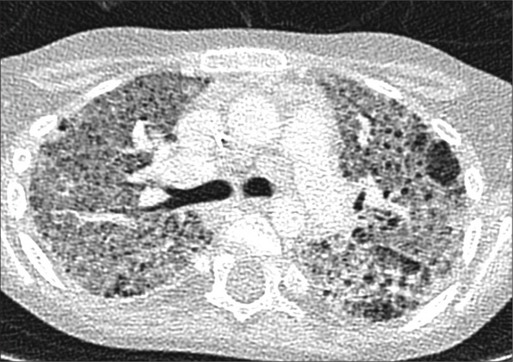 A 6-year-old girl with a progressive interstitial lung disease, consisting of ground-glass opacification and cyst formation, subsequently found to have genetics consistent with stimulator of interferon genes.