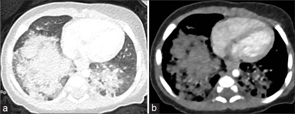 A 2-month-old Zimbabwean boy with dense consolidation in the lower lobes and areas of low attenuation (best demonstrated on the soft-tissue window image) in keeping with exogenous lipoid pneumonia from oral administration of oils as prophylaxis against constipation. There is an important association with atypical infective organisms, particularly non-tuberculous mycobacteria, (a) Lung window, (b) Bone window.