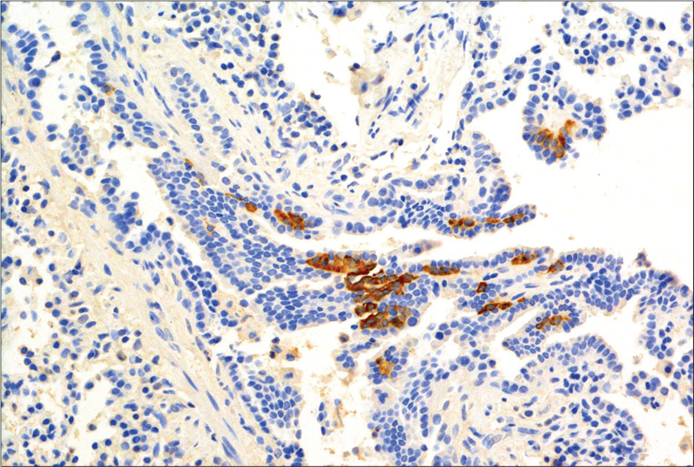 Histology of neuroendocrine cell hyperplasia of infancy. There is obvious positive staining for bombesin-positive cells in the airway.