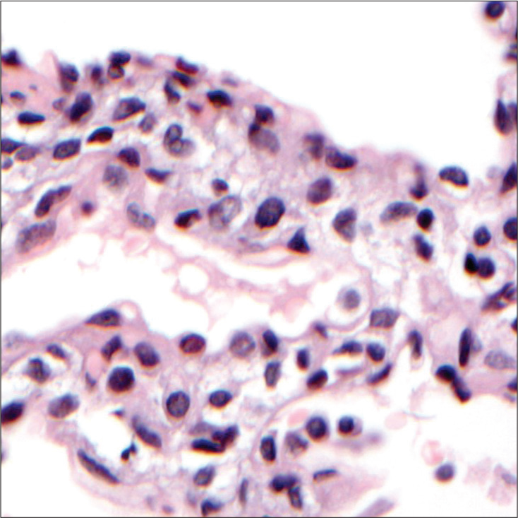 Pulmonary interstitial glycogenosis. There is expansion of the interstitium, with vacuolated cells from which glycogen has been leached out during processing.