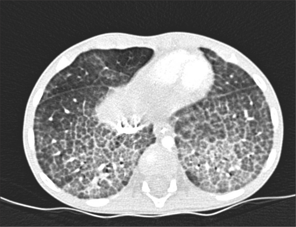 A newborn with the typical “crazy-paving” appearance of pulmonary alveolar proteinosis (pulmonary alveolar proteinosis [PAP], diffuse ground-glass opacification with superadded interlobular septal thickening). The lack of pleural effusions shifts diagnostic suspicion away from the common mimics of PAP such as edema and lymphangiectasis/lymphangiomatosis. This child was later found to have a mutation in the gene coding an alpha subunit of the granulocyte-macrophage colony-stimulating factor (GM-CSF) receptor (GM-CSFR2A).