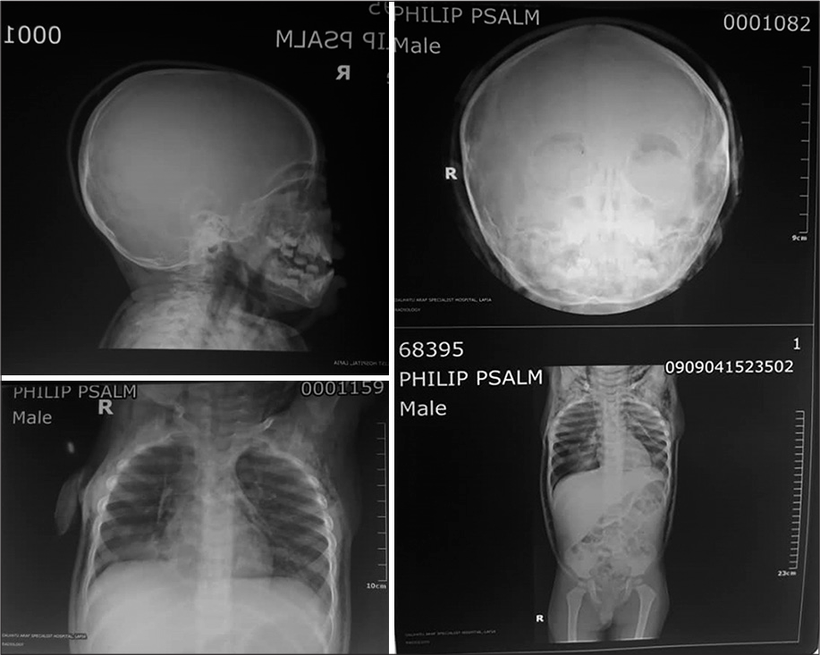 Babygram showing air trapping under the skin of skull, neck and thorax.