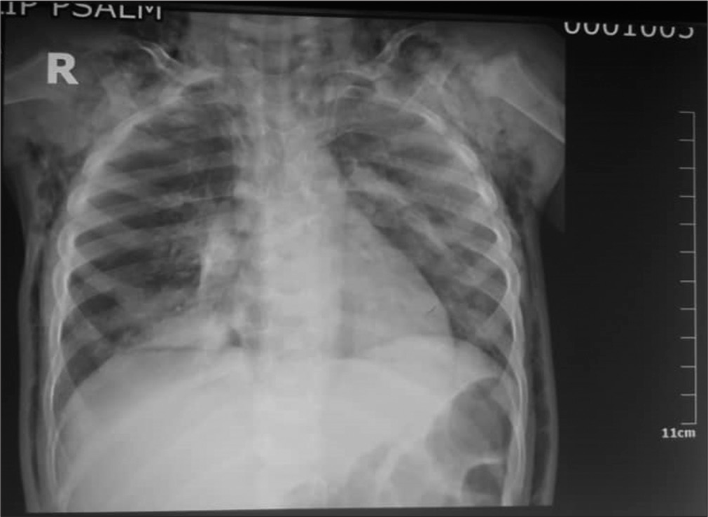 CXR showing minimal pneumothorax.