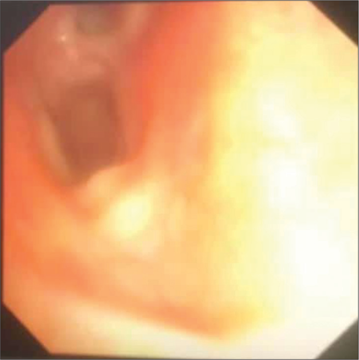 Multiple glistering lesions on the lateral and posterior walls of the right main bronchus.