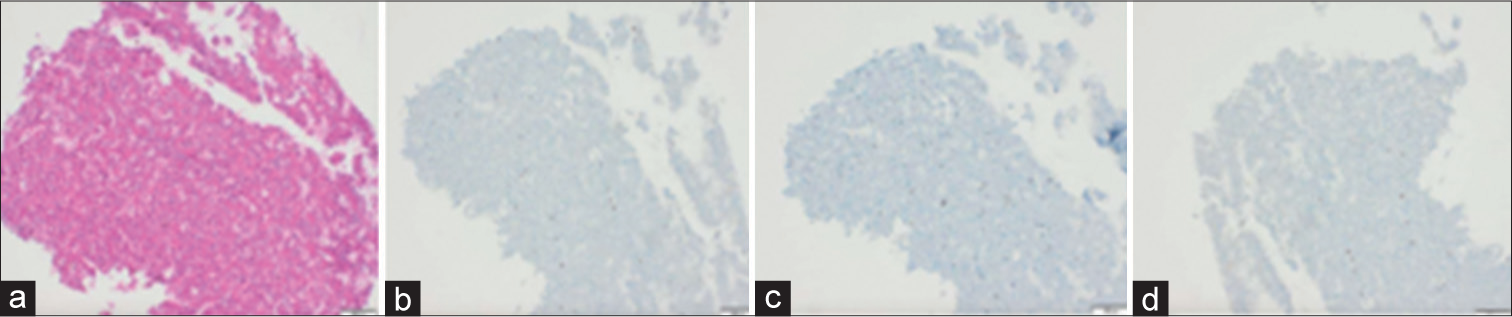 The histology slides of biopsy sample showing (a) clusters and singly occurring atypical cells with foamy to vacuolated cytoplasm and vesicular to hyperchromatic nuclei (hematoxylin and eosin stain), negative immunostaining to (b) novel aspartic proteinase of the pepsin family A (Napsin A), (c) pan-cytokeratin (pan-CK), and (d) thyroid transcription factor-1.