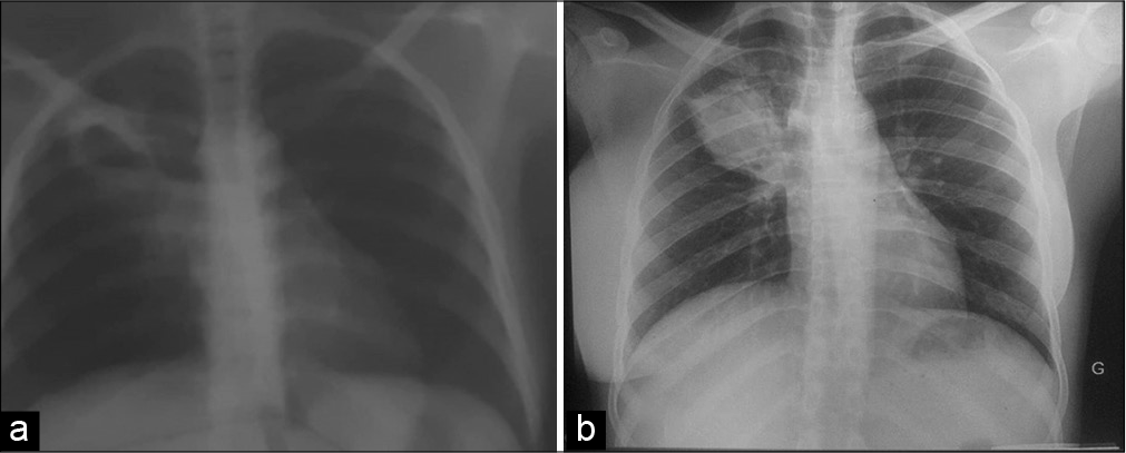 (a) Chest radiography showing the progression from an excavated lung lesion with thickened walls initially (b) to a pseudo-nodular lung lesion after three months.