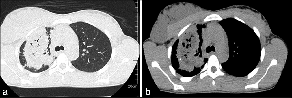 (a): Transverse parenchymal CT scan showing a spiculated apical mass with areas of necrosis. (b) Mediastinal CT scan showing a right apical heteronodular lesion; multi-cavity with central necrosis.