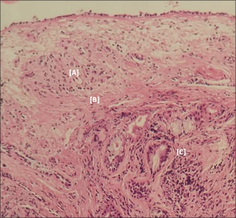 Cyto-histological appearance suggestive of caseous-exudative tuberculous bronchitis (zoom x 10) [A]: gigantocellular epithelioid granuloma [B]: zone of caseous necrosis [C]: bronchial glands