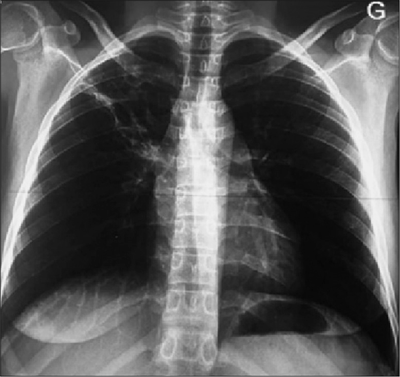 Chest x-ray at the end of treatment showing complete regression of the right apical lesion after 6 months of complete treatment.