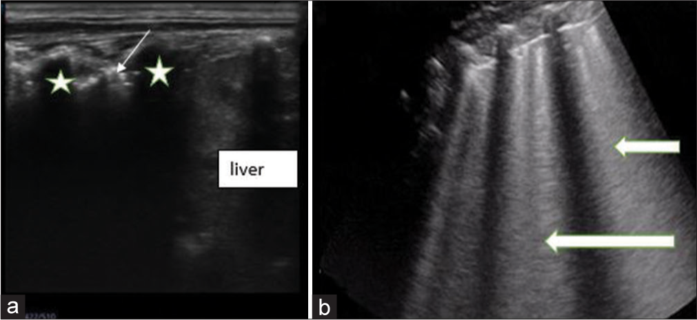 Sagittal views on lung ultrasound of a child (a) shows the area of consolidation with air bronchogram seen as echogenic foci (slim arrow) within it. Acoustic shadows from the ribs are noted (*). While the liver is seen inferior to the ribs (b) shows florid B-lines (block arrows) arising from the pleural lines.