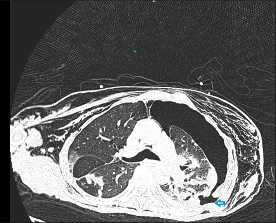 Axial cut of a computed tomography chest showing a large left pneumothorax with an arrowhead pointing to the fistula location.
