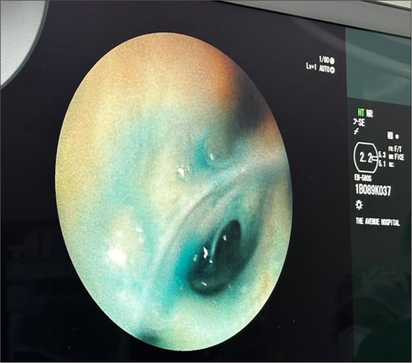 Methylene blue dye leaking through the LB6 bronchus.