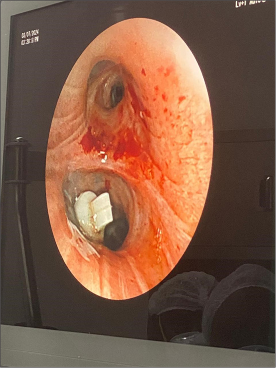 Bronchoscopic view of spigot placement in LB6.