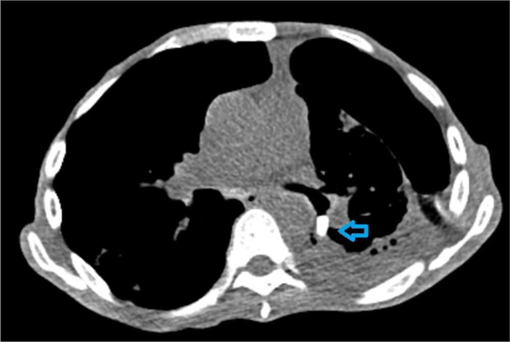 Axial cut of a computed tomography chest showing the spigot in place in the LB6 bronchus (arrowhead).