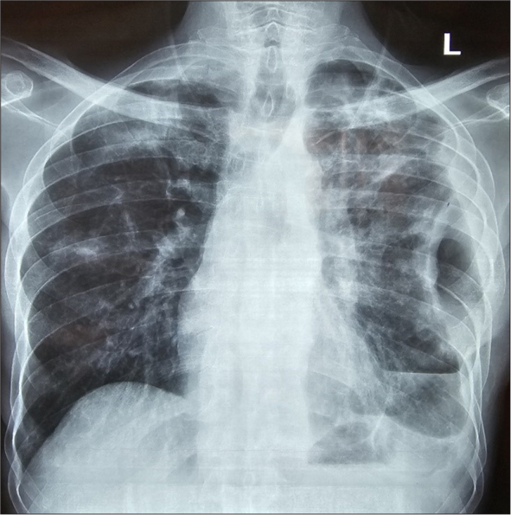 Chest radiograph taken 3-week post-spigot placement. The chest drain has been removed and there is a significant reduction in the pneumothorax.